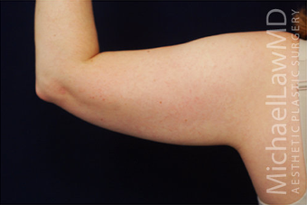 Liposuction