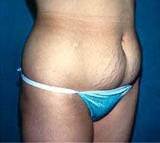 Smartlipo