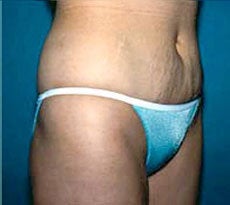 Smartlipo