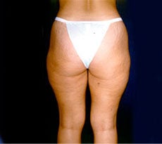 Smartlipo