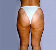 Smartlipo