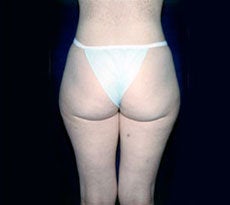 Smartlipo