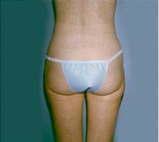 Smartlipo