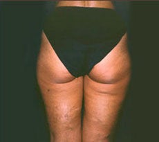 Smartlipo