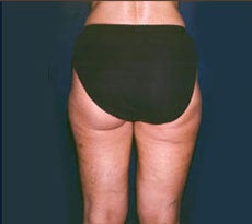 Smartlipo