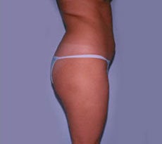 Smartlipo