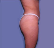 Smartlipo
