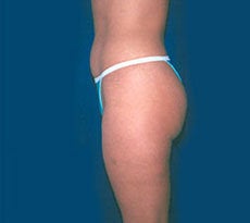 Smartlipo