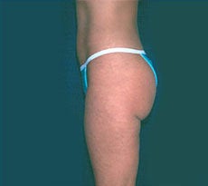 Smartlipo