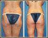liposuction
