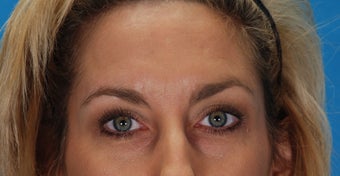 Botox