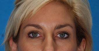 Botox