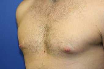 Smart-Lipo of the Chest, Liposuction, Gynecomastia