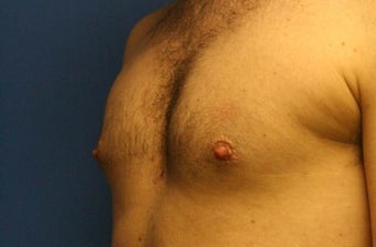 Smart-Lipo of the Chest, Liposuction, Gynecomastia