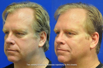 Radiesse Injection in Cheeks