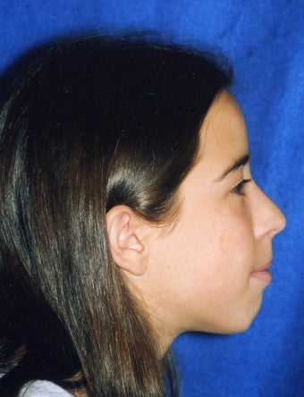 Orthodontic braces with miniscrew anchorage