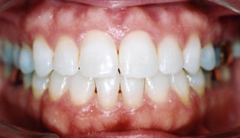 Orthodontic braces with miniscrew support to close openbite