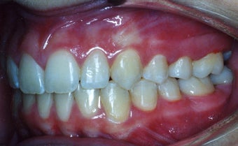 Orthodontic braces to correct a Class II malocclusion