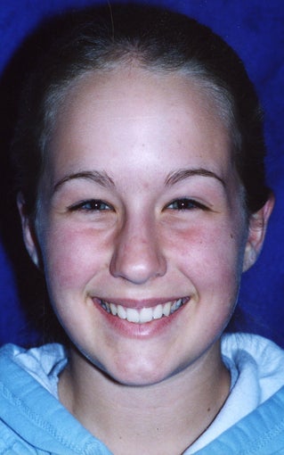 Orthodontic braces to correct a Class II malocclusion