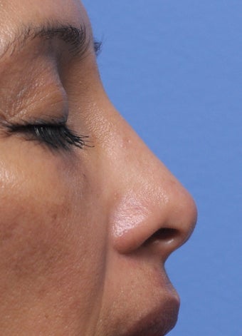 Non Surgical Rhinoplasty