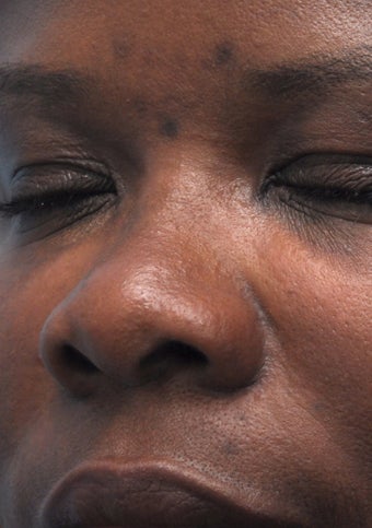 Non Surgical Rhinoplasty
