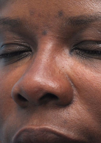 Non Surgical Rhinoplasty