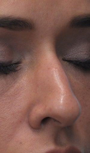 Non Surgical Rhinoplasty