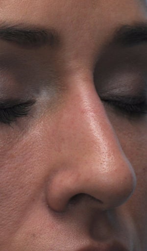 Non Surgical Rhinoplasty