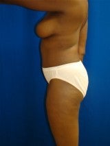 Mommy Makeover