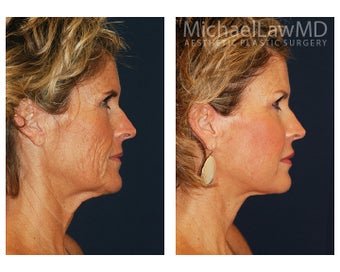 Facial Rejuvenation
