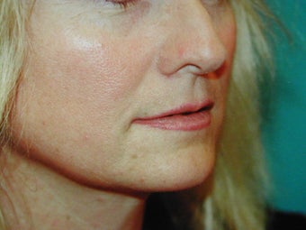 Sub Nasal Lip Lift