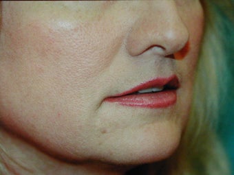 Sub Nasal Lip Lift
