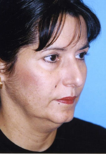 Chin Implant