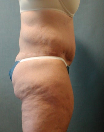 Lower Body Lift