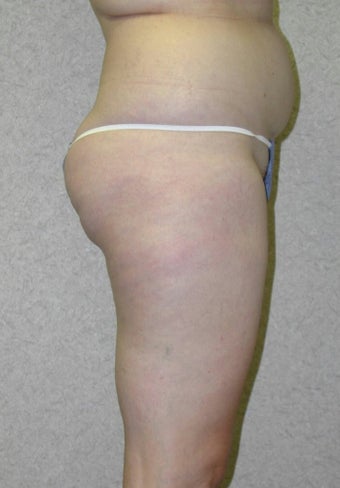 Lower Body Lift