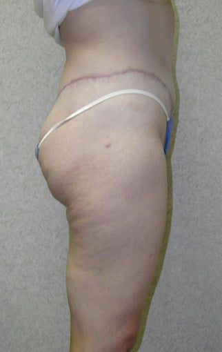 Lower Body Lift