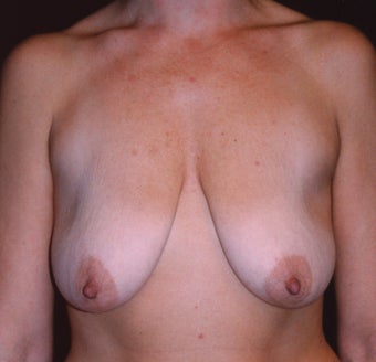 Breast Mastopexy