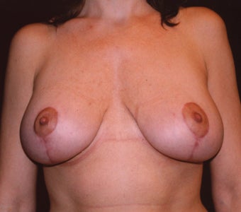 Breast Mastopexy