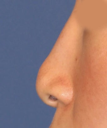 Revision Rhinoplasty