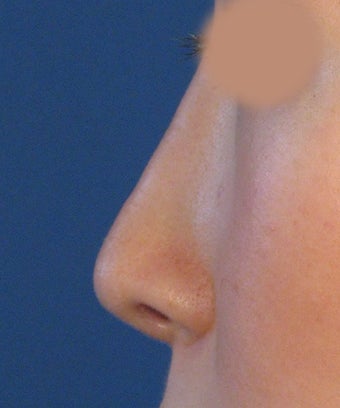 Revision Rhinoplasty