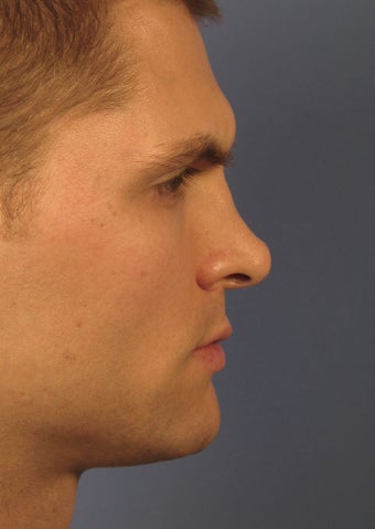 Revision Rhinoplasty
