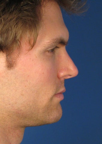 Revision Rhinoplasty