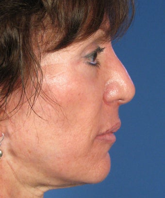 Revision Rhinoplasty