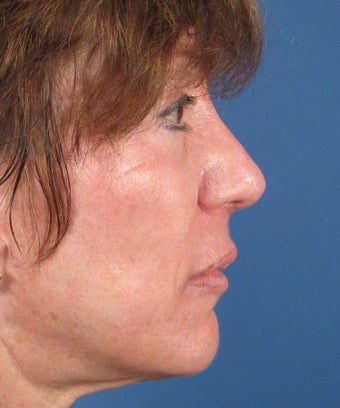 Revision Rhinoplasty