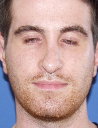 Revision Rhinoplasty