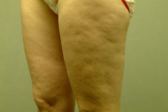 Smart Lipo-Liposuction