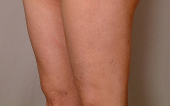 Smart Lipo-Liposuction
