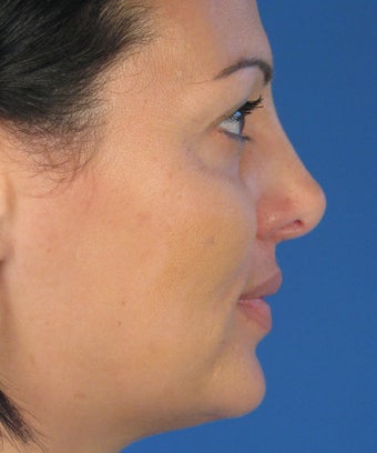 Revision Rhinoplasty