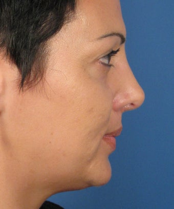 Revision Rhinoplasty