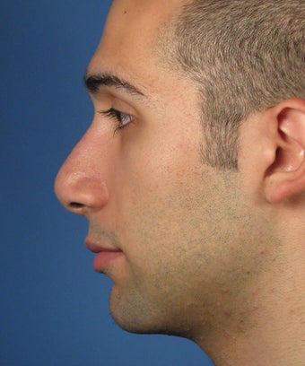 Revision Rhinoplasty